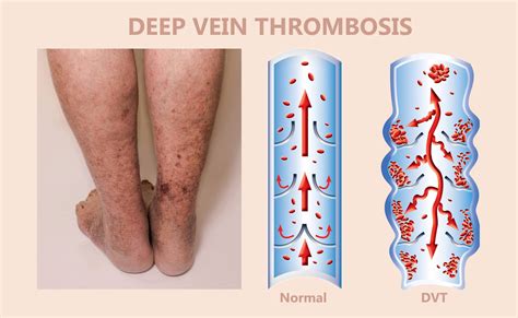 vein hard after blood test|bleeding veins on legs.